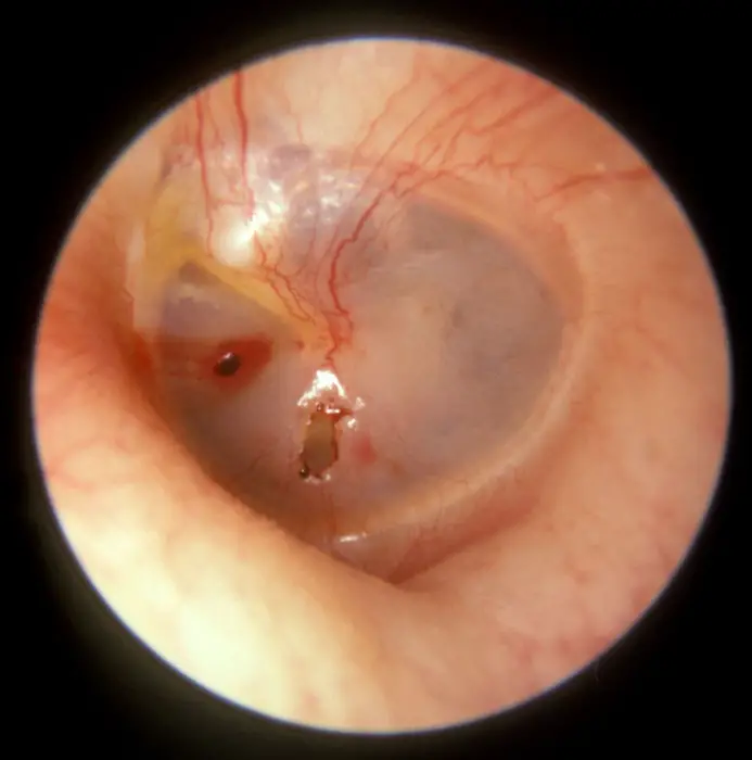 Tympanic Membrane